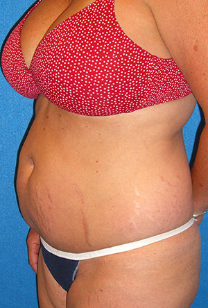 Tummy Tuck