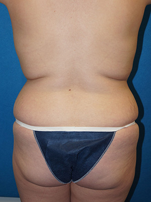 Tummy Tuck