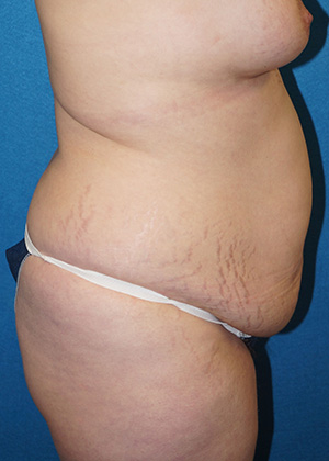 Tummy Tuck