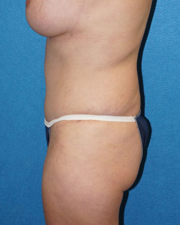 Tummy Tuck