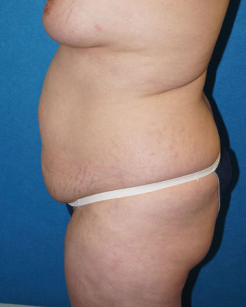 Tummy Tuck