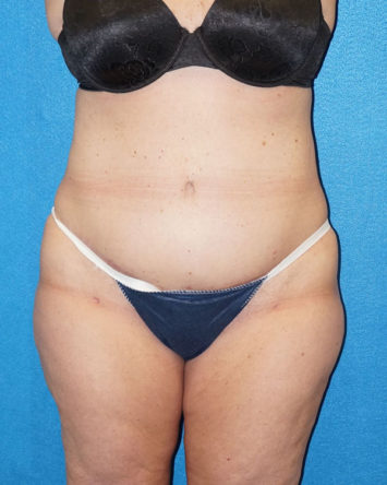 Tummy Tuck