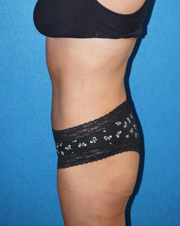 Tummy Tuck