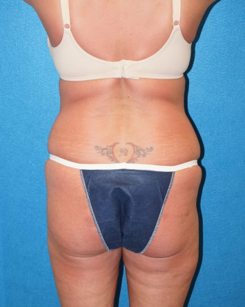 Tummy Tuck