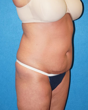 Tummy Tuck