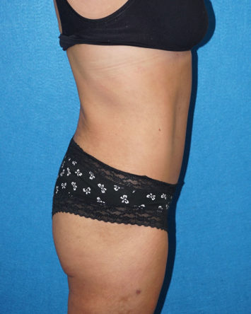 Tummy Tuck