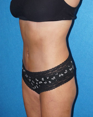 Tummy Tuck