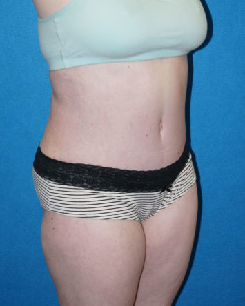 Tummy Tuck